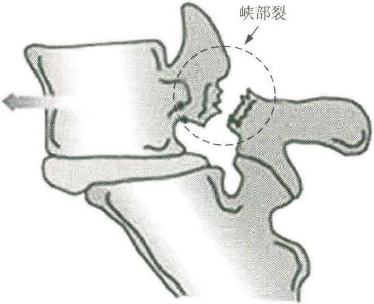 第一節(jié) 腰椎滑脫癥